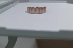 full arch bridgework retained by dental implants