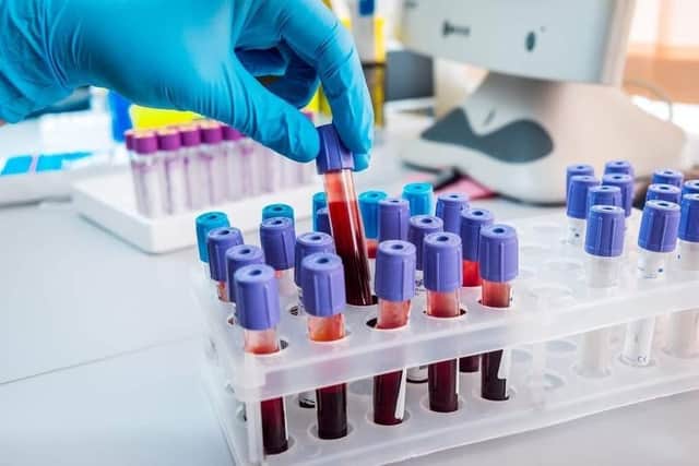 Should HIV screening happen automatically if you have a blood test at the Royal Preston's A&E department?