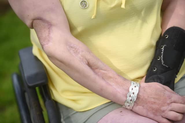 Emma Doherty has been left permanently disfigured and in a wheelchair after contracting necrotising fasciitis, also known as the "flesh-eating disease" and feels let down by support from the NHS.