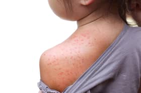 A child has died in a UK hospital from measles. Photo: stock.adobe.com