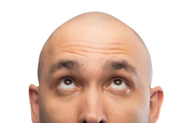 I've embraced thinning on top. Photo: Adobe