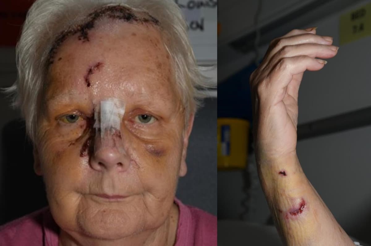 'I am absolutely terrified of any dog now': Pensioner savagely attacked by Staffordshire Bull Terrier speaks out
