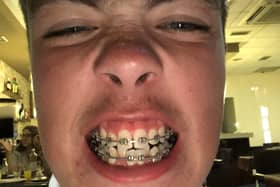 Thomas Grundy has received a payout after dental treatment 'blighted' his teenager years. The dentist involved admitted liability.