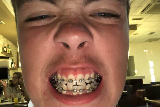 Thomas Grundy has received a payout after dental treatment 'blighted' his teenager years. The dentist involved admitted liability.