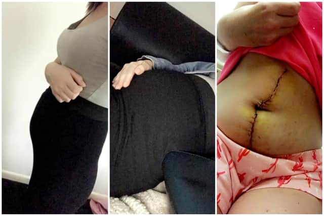 Two images on the left: Sarah's swollen stomach from ovarian cancer. Right: post hysterectomy.