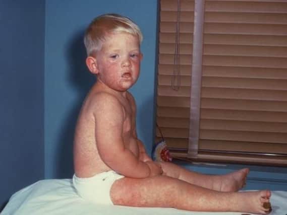 A child suffering from measles. The illness can lead to blindness and even death in rare cases