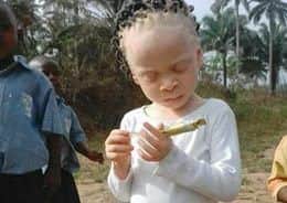 Iyang, the little girl with albinism.