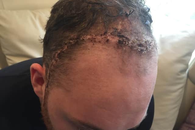 The scars to Ben's head following surgery
