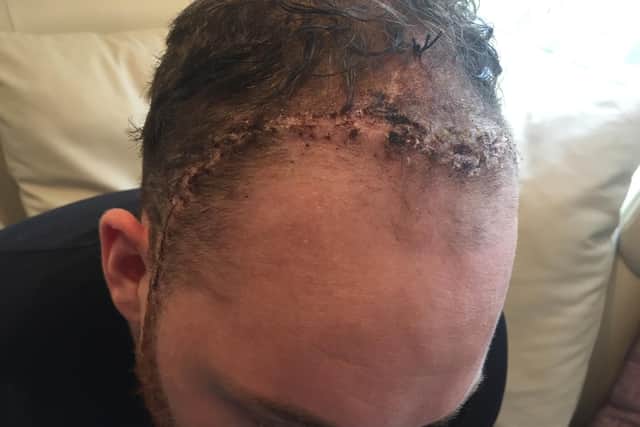 Ben had to have surgery to remove the front of his skull in order to save his life