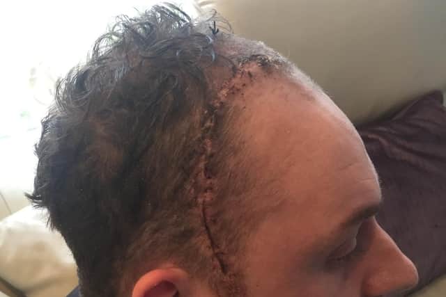 Ben had to have surgery to remove the front of his skull in order to save his life