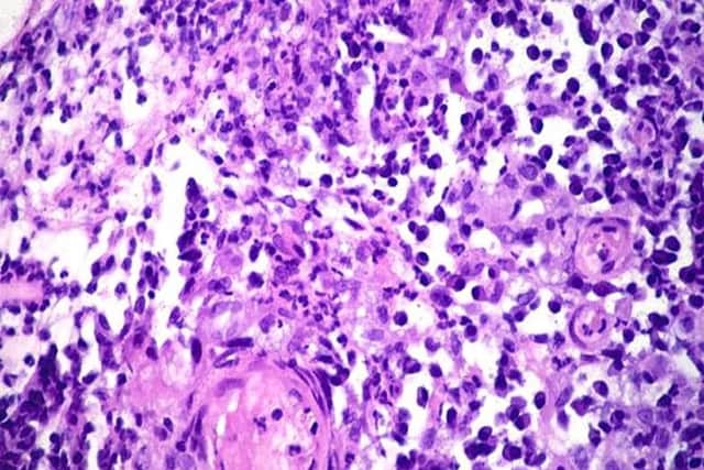 Donovanosis - Image: American Urological Association