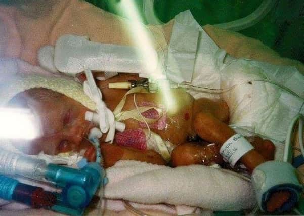 Shannon Buck as a baby. Shannon was born premature 13 weeks early and almost died.
Shannon is now 18 and has done really well in her A-levels and is going off to university.