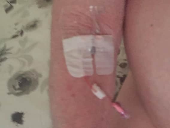 The cannula in Eric Danson's arm after he was discharged from Chorley and South Ribble Hospital