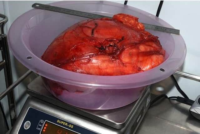 The 4kg tumour removed from Beverley Jaundrill's stomach. Photo: Royal Liverpool Hospital