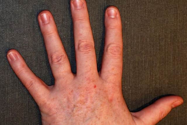 A photo of your hand could help this research and make you part of a citizen science project