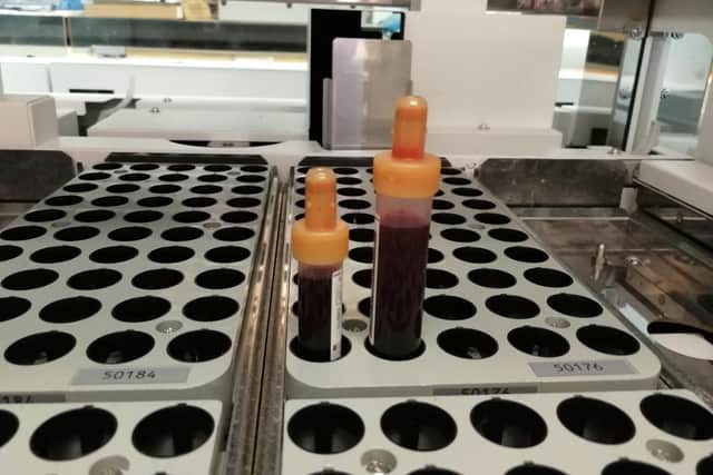 The current and previous testing tubes used for some inpatient blood samples