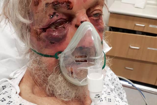 An 80-year-old pensioner who suffered multiple injuries, including a broken wrist, nose and cheekbone in what detectives have described as a "nonsensical" attack in a street in Penge, south-east London.