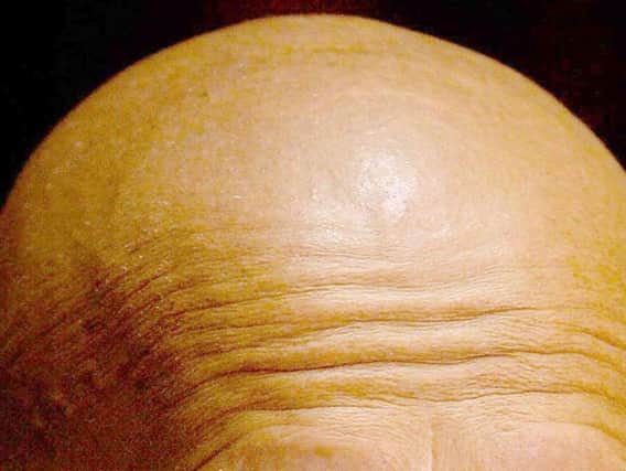 A cure for baldness could be within sight