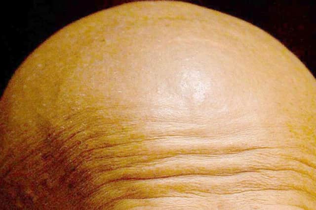 A cure for baldness could be within sight