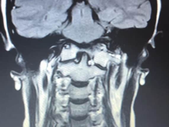 MRI scan taken from Spire South Bank Hospital Worcester
which shows how Rachel Pighills' brainstem is bent due to it being compressed by the odontoid. It also shows how her brain is sagging and her c1 vertebrae is assimilated to the skull base