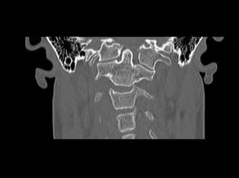 CT image taken at Spire Hospital Bristol showing Rachel Pighills' atlas assimilation, how the spine is starting to curve with Scoliosis and that the C2 vertebrae is out of position