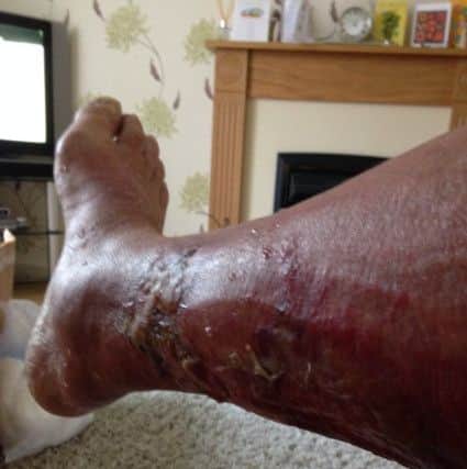 Garry Darton, who was bitten on holiday in Cuba which later became infected by something and developed into cellulitis.
Doctors say it was so serious, he could have lost his leg.