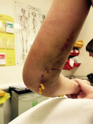 Ethan Fitzgerald, 13, from Chorley, and his injury after a rugby match for the Chorley Panthers.