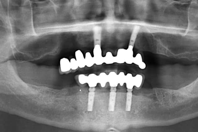 An X Ray of James Clay's mouth. He has received Â£18,000 in an out of court settlement from Dr Roger Hughlock