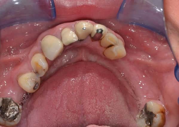 Richard Odgen's teeth