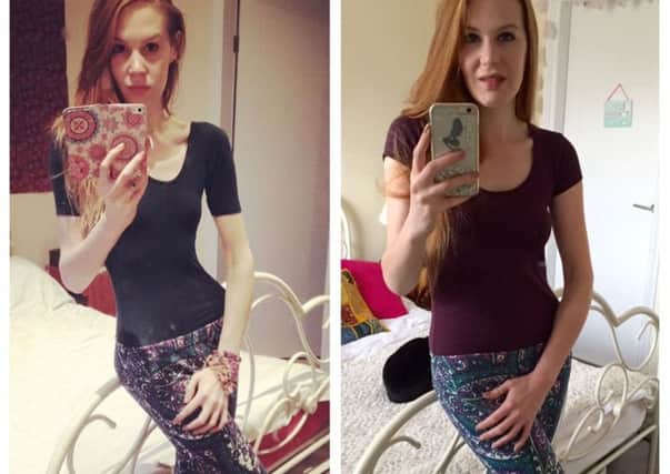 Ruby Henderson who has battled anorexia then and now