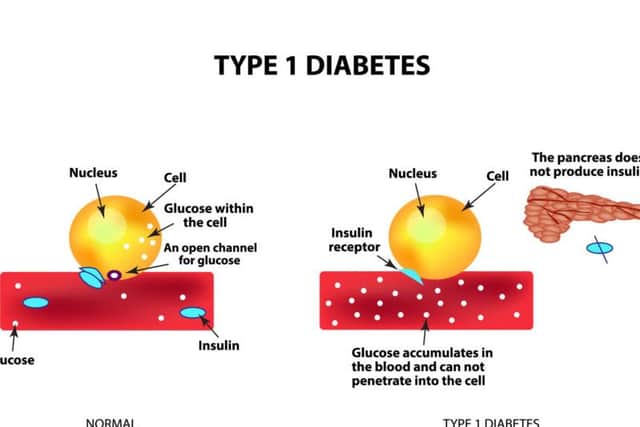 Infographic on Type 1 Diabetes