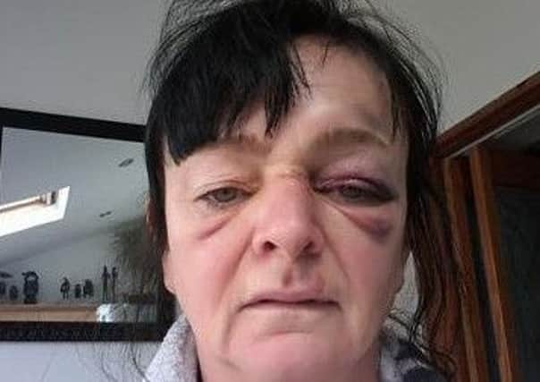 Marilyn Taylor nursing two black eyes and a gashed nose after the collision
