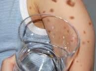In this example the spots are still visible through the glass. This is called
a non-blanching rash - it does not fade. Seek immediate medical help if you see this sign.
.