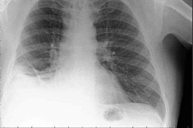 The blockage in the bottom right of the X-Ray