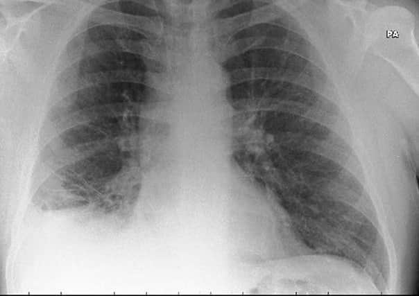 Paul's lungs once the toy cone was removed