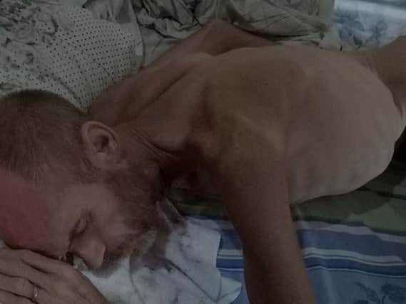An emaciated Ronnie Lord in hospital in the Philippines. His condition means he cannot eat